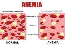 Tens anèmia ferropènica? Compte amb la inflamació anemia ferropénica inflamación anèmia ferropènica inflamació