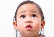 Alimentación para niños y adultos con dermatitis atópica Alimentación para niños y adultos con dermatitis atópica