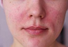 Com es fa una crema per a la pell amb rosàcia crema para la piel con rosácea