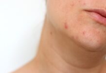 Tractament de l’acne, amb Pielsana acné