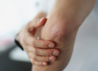 Explorando la psoriasis: causas y tratamiento psoriasis